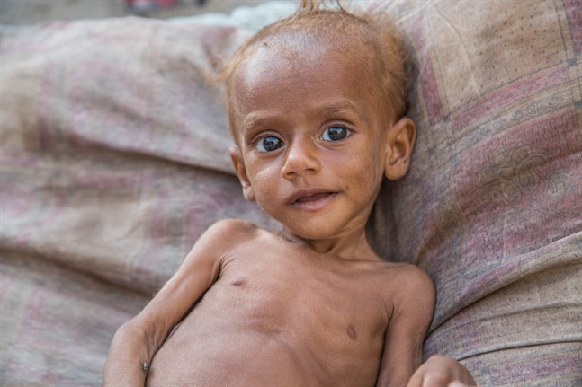 Den 13 månader gamla, svårt undernärda pojken Nusair fick vård i oktober och klarade sig tack vare Rädda Barnens humanitära hjälp i Hoidedah, Jemen.