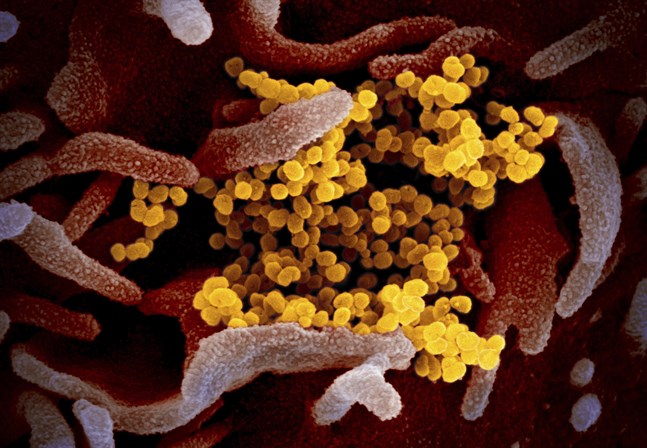 Elektronmikroskopibild av hur det nya coronaviruset (gulfärgat) tar sig ut ur en infekterad cell.