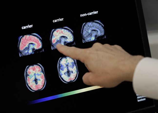 USA:s läkemedelsverk FDA har godkänt bioteknikföretaget Biogens behandling mot Alzheimers sjukdom. Arkivbild.